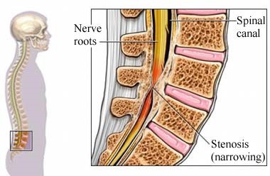 an illustration of a spine where narrowing has occurred, and the nerves of the spine are being pinched